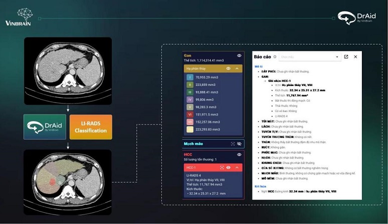 Giao diện hiển thị kết quả của DrAid CT Ung thư Gan